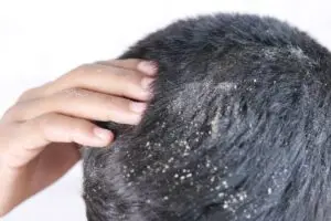 men with dandruff in his hair, closeup .